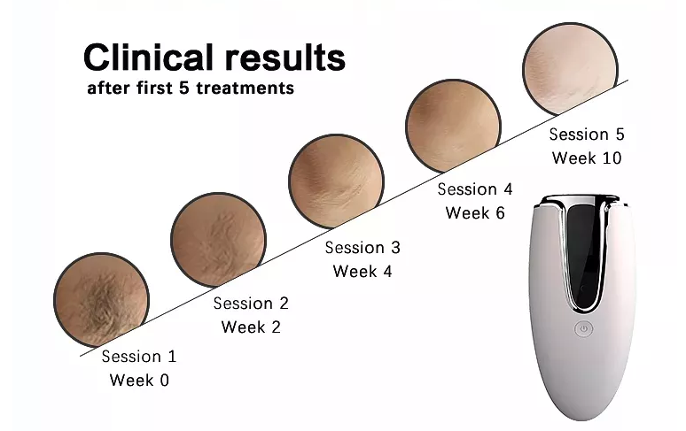 منتجات منزلية شائعة آلة إزالة الشعر بالليزر المحمولة باليد لإزالة الشعر بالليزر في المنزل