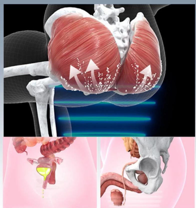 وسادة كرسي عضلات قاع الحوض علاج كرسي قاع الحوض إصلاح EMS كرسي قاع الحوض