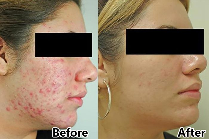 جهاز علاج الوجه بالضوء الأحمر لعلاج حب الشباب وتجديد شباب البشرة بعلاج الضوء الديناميكي الضوئي بقيادة CE المعتمدة