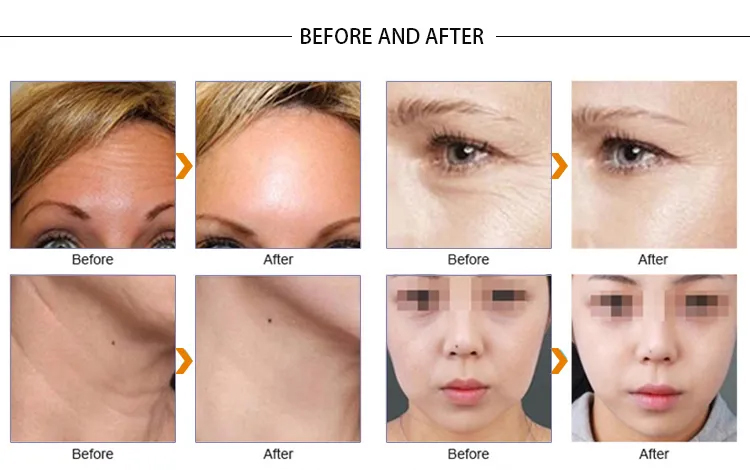 آلة شد الجلد عالية التردد لعام 2023 VDHF rf radio أفضل جهاز لإزالة التجاعيد ومعدات العناية بالوجه رفع ملامح الوجه