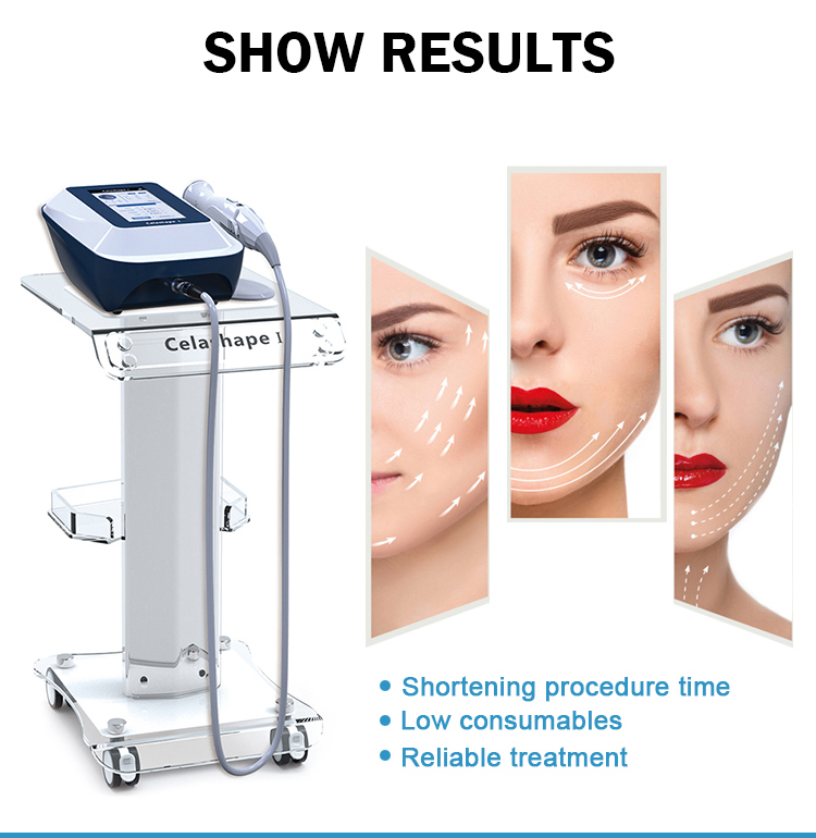 صورة لنتائج علاج Vacuum RF