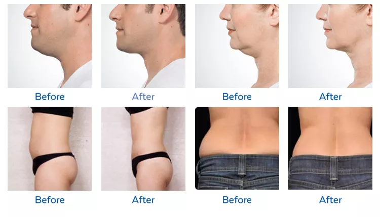 آلة كريو 360 لعام 2022، آلة تكسير الدهون بالتبريد بأسعار أفضل لإنقاص الوزن عن طريق تكسير الدهون بالتبريد