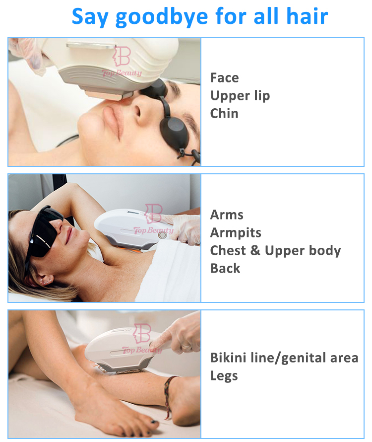 آلة إزالة الشعر بالضوء النبضي المكثف من نوع جديد