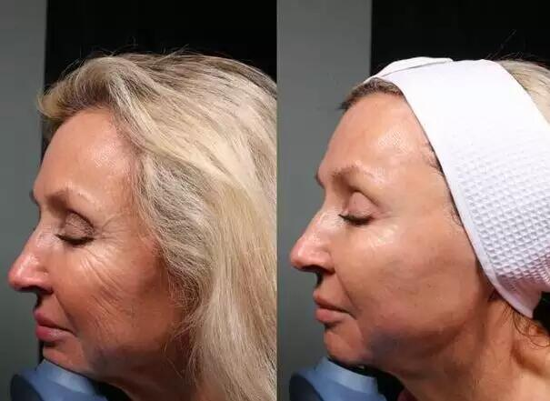 جهاز تجميل الوجه بالموجات فوق الصوتية المركزة عالية الكثافة لإزالة تجاعيد الوجه وشدّه وتنحيف الجسم بجهاز HIFU Vmax 8D