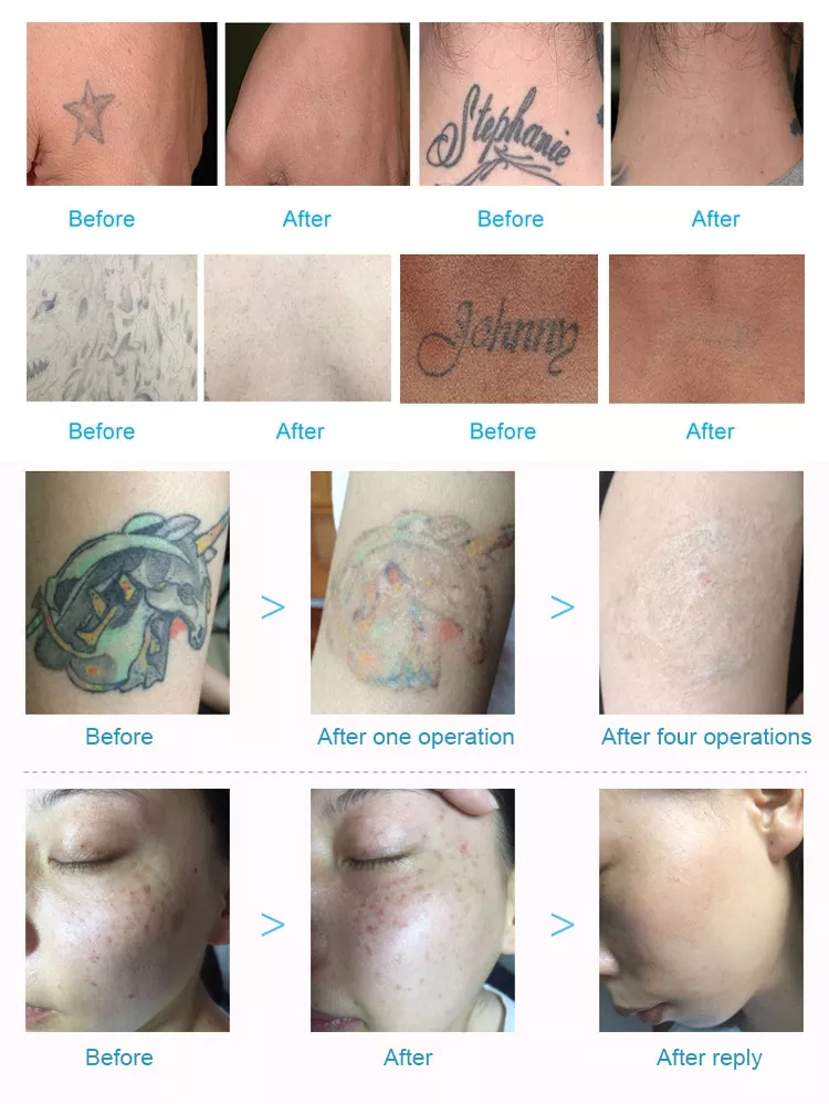 آلة إزالة الوشم بالليزر بيكو Q Switch Nd Yag Laser