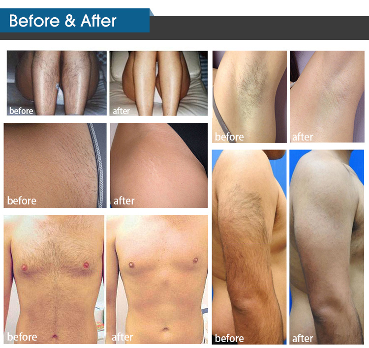 آلة إزالة الشعر بالليزر الثنائي 808nm الاحترافية