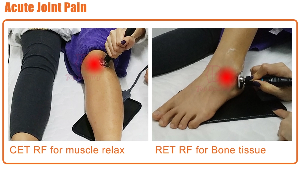 علاج تيكار للعلاج الطبيعي جهاز تيكار أحادي القطب مقاوم وتكثيفي تيكارتيرابيا احترافي