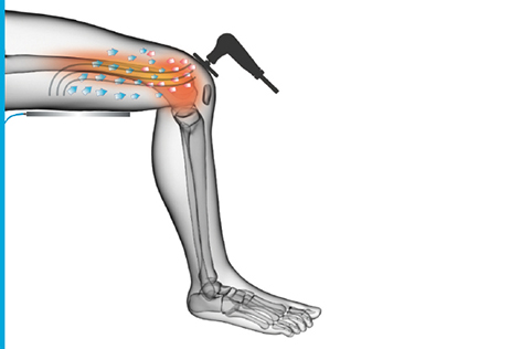 صورة توضح تطبيق تقنية TECAR