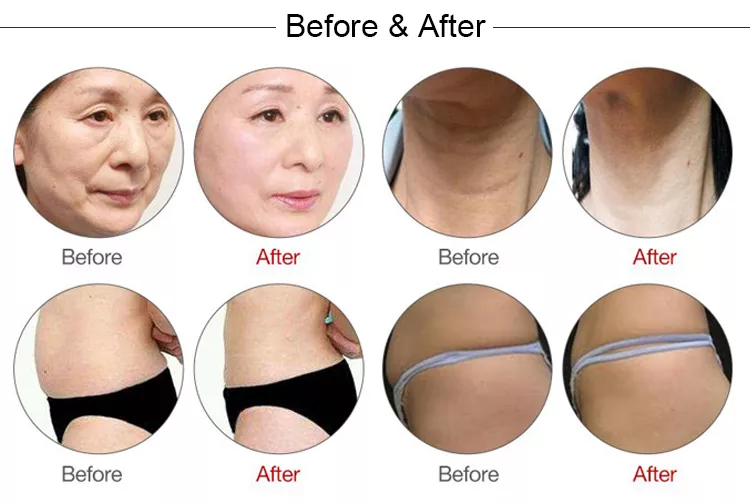 جهاز إعادة تأهيل الجلد بالموجات فوق الصوتية مع دوران 360 درجة لإزالة التجاعيد، جهاز MMFU الرأسي 4D