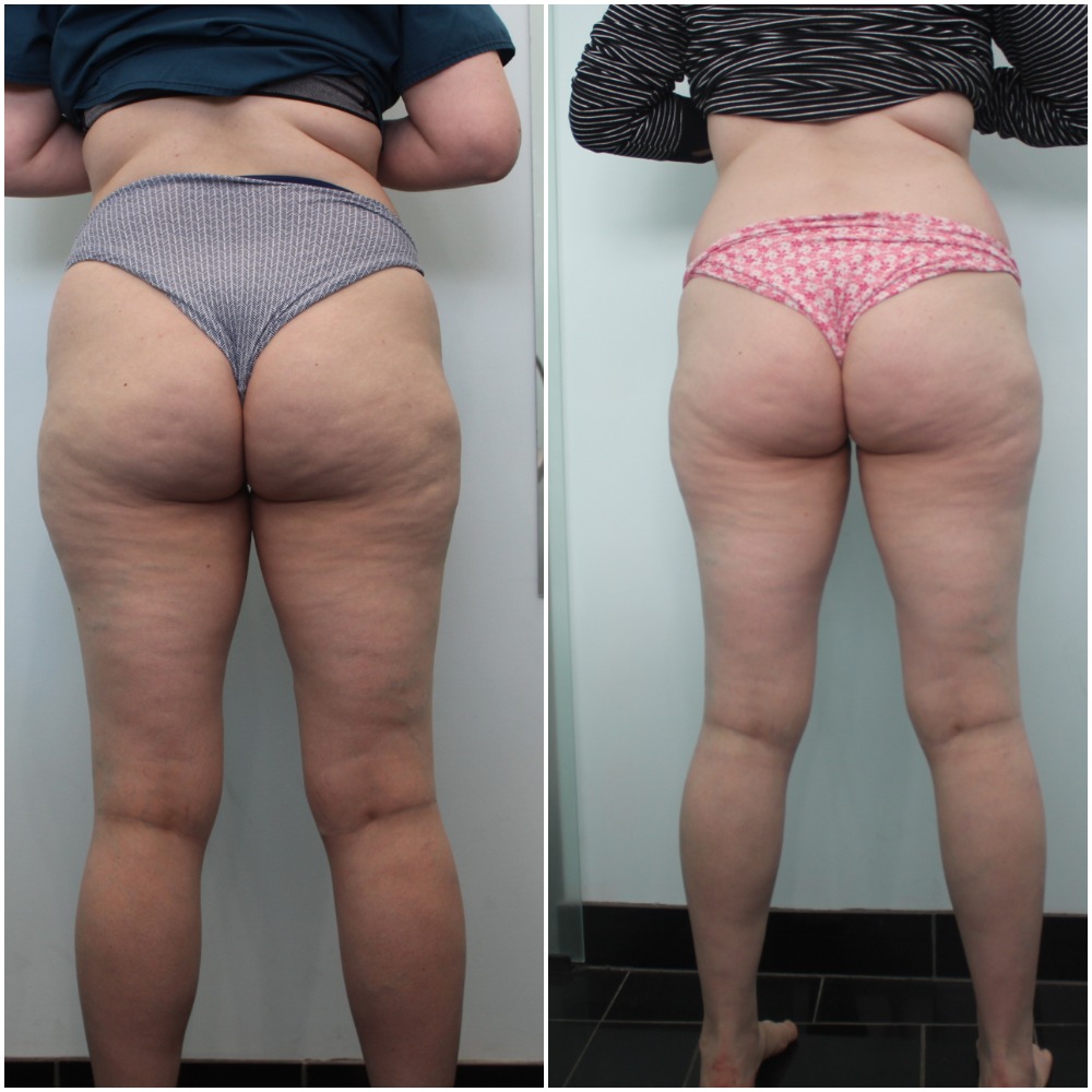 آلة تصميم الجسم Endosphere لتصريف اللمف الداخلي بكرة العضلات مساج تقليل السيلوليت معدات التنحيف