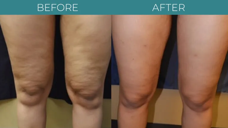 آلة تصميم الجسم Endosphere لتصريف اللمف الداخلي بكرة العضلات مساج تقليل السيلوليت معدات التنحيف