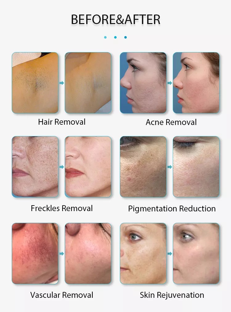 آلة إزالة الشعر بالضوء النبضي المكثف من نوع جديد