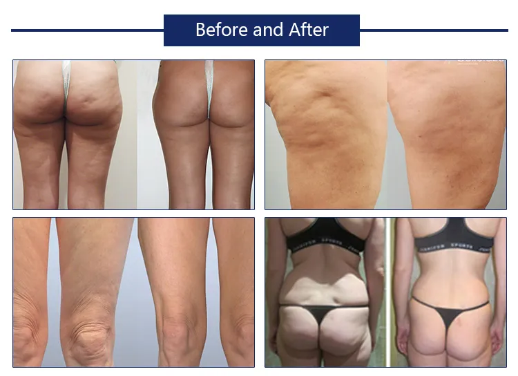 أفضل سعر لآلة نحت الجسم بالتبريد الدهون تجميد