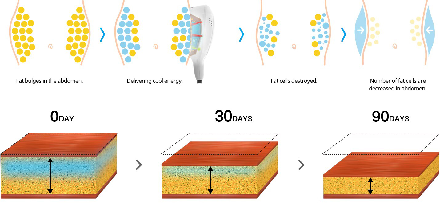 أفضل سعر لآلة نحت الجسم بالتبريد الدهون تجميد