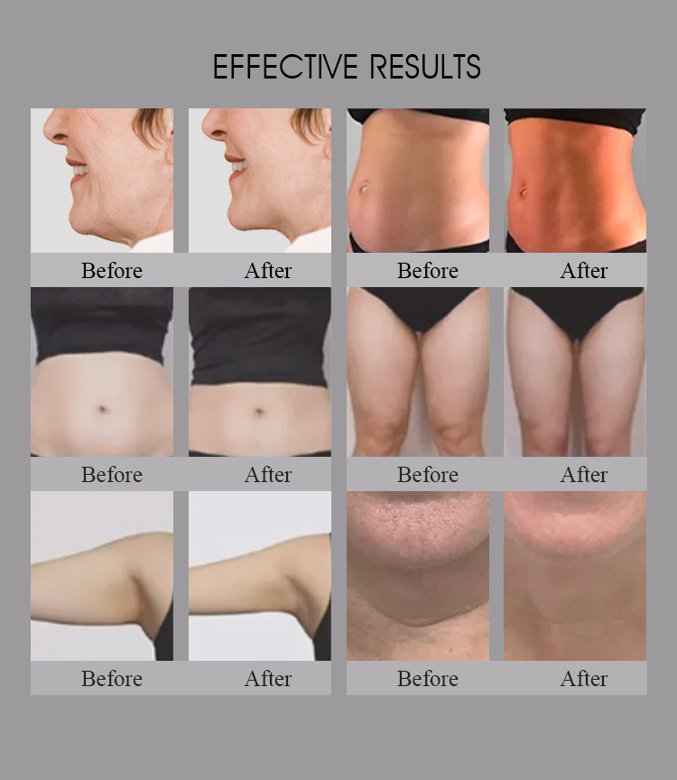 3 في 1 صالون استخدام Trusculpt Id Flex Rf نحت الجسم نحت الجسم 2 ميجاهرتز علاج السيلوليت تقليل الدهون آلة Trufat