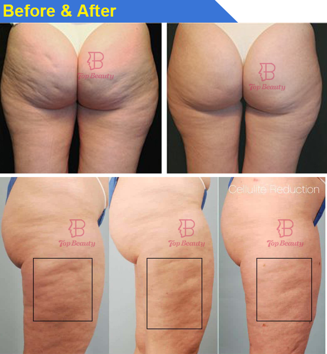 جهاز تدليك إندوسفيرز بكرات لعلاج السيلوليت