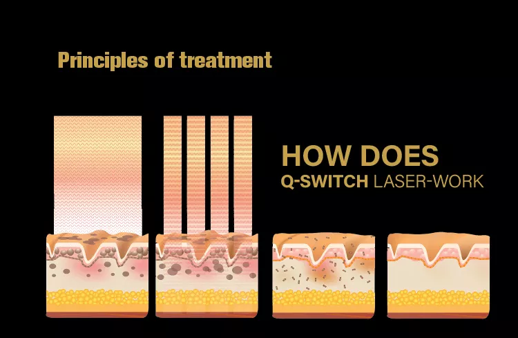 آلة إزالة الوشم بالليزر بيكو Q Switch Nd Yag Laser