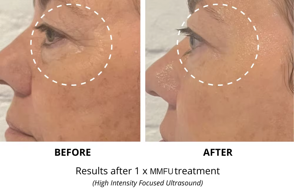 آلة شد الوجه والجسم هيفو 7D RF ذات الوظيفتين