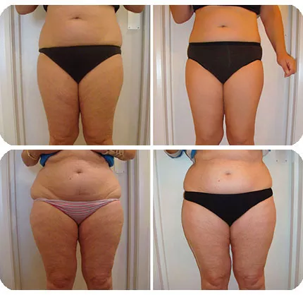 جهاز ضغط هوائي احترافي للتدليك بالضغط علاجي تصريف اللمفاوي لتنحيف الجسم