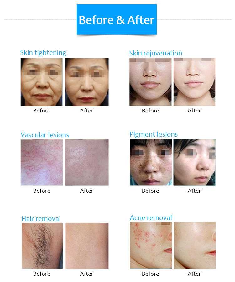 آلة إزالة الشعر بالليزر ثنائي القطب DPL فوتون تجديد شباب الجلد ورفع وعلاج التجاعيد وآلة تجميل