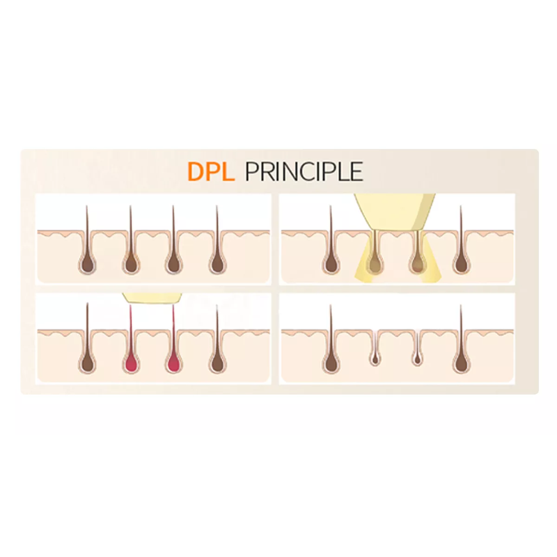 آلة إزالة الشعر بالليزر ثنائي القطب DPL فوتون تجديد شباب الجلد ورفع وعلاج التجاعيد وآلة تجميل