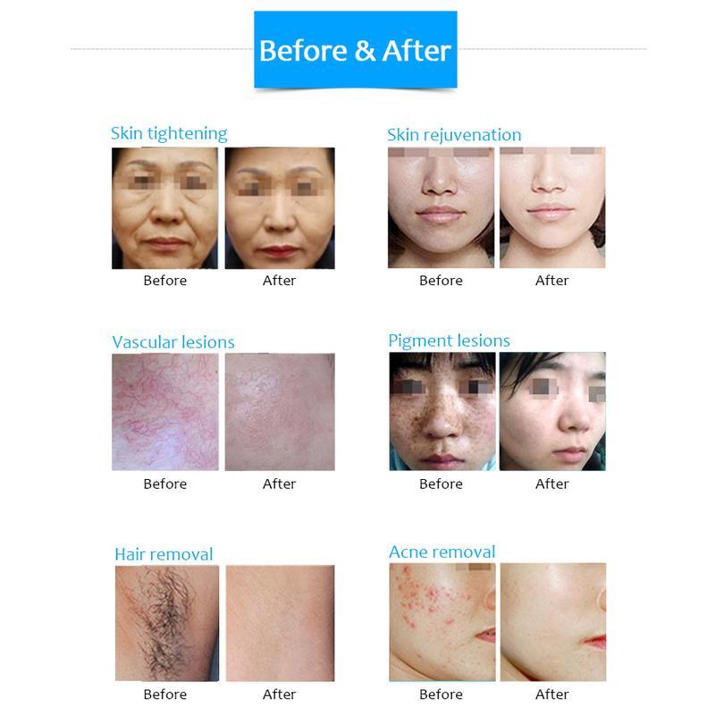 آلة إزالة الشعر بالليزر ثنائي القطب DPL فوتون تجديد شباب الجلد ورفع وعلاج التجاعيد وآلة تجميل