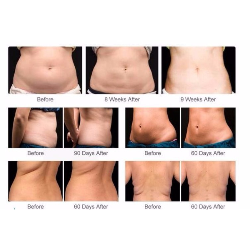 أفضل سعر لآلة نحت الجسم بالتبريد الدهون تجميد