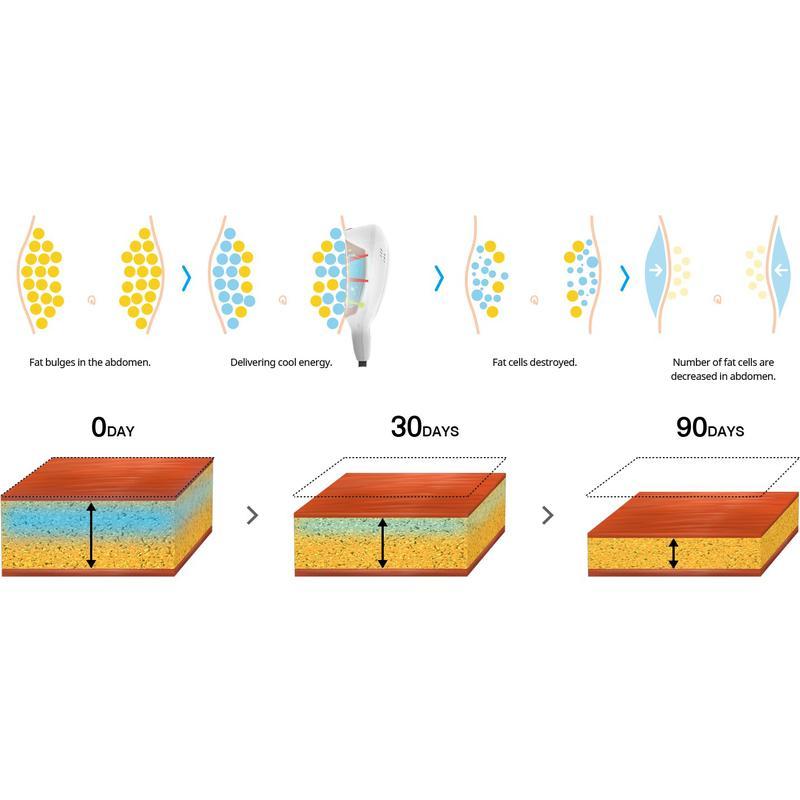 أفضل سعر لآلة نحت الجسم بالتبريد الدهون تجميد