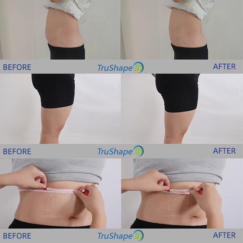 آلة Trushape ID للعلاج بالتحفيز الكهربائي للعضلات ونحت الجسم Emslim