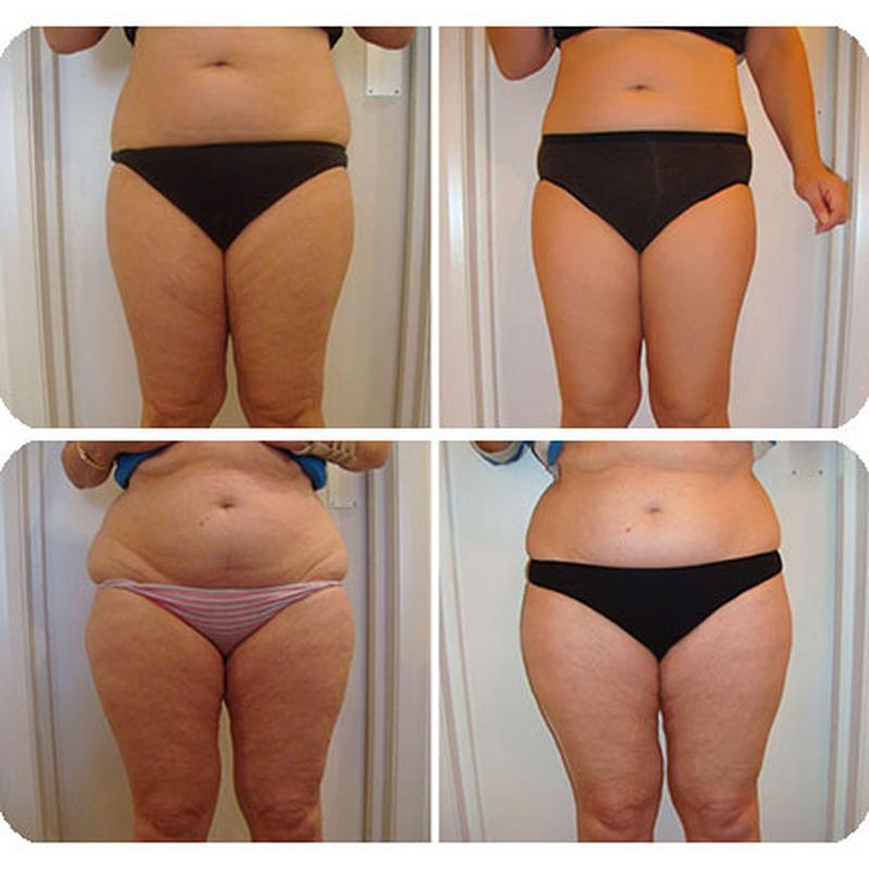 جهاز تروتشيب آي دي إي إم إس لتحفيز العضلات الكهربائي لتشكيل الجسم