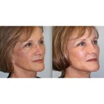 آلة الترددات الراديوية Mmfu Cyclone Rf شد الوجه بدون ألم آلة Rf لشد الجلد وإزالة التجاعيد