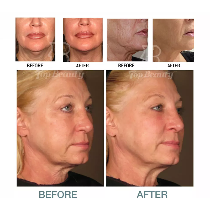 جهاز إعادة تأهيل الجلد بالموجات فوق الصوتية مع دوران 360 درجة لإزالة التجاعيد، جهاز MMFU الرأسي 4D