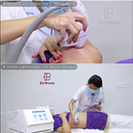 1,000,000 طلقة تبريد جليدي 8D HIFU 5D Smas رفع آلة العناية بالبشرة الجليدية