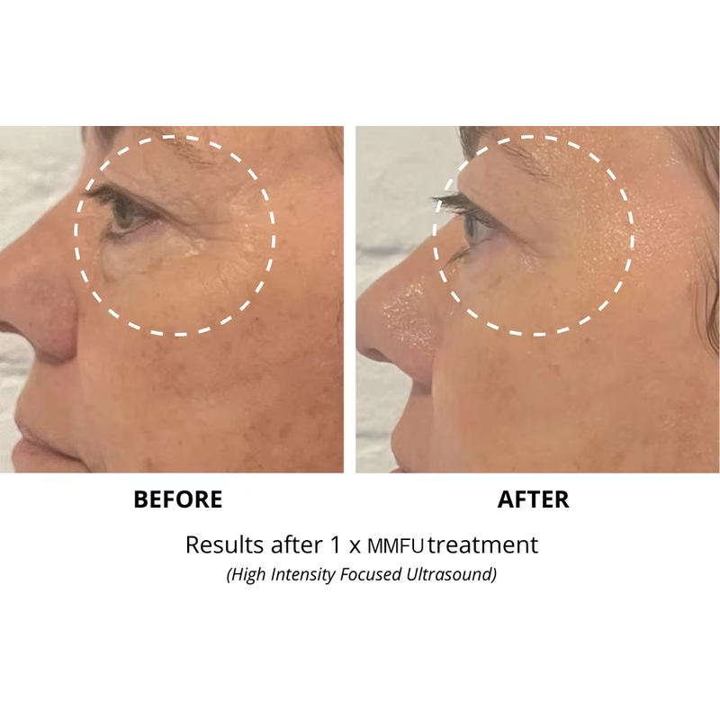 آلة شد الوجه والجسم هيفو 7D RF ذات الوظيفتين