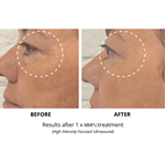 آلة شد الوجه والجسم هيفو 7D RF ذات الوظيفتين