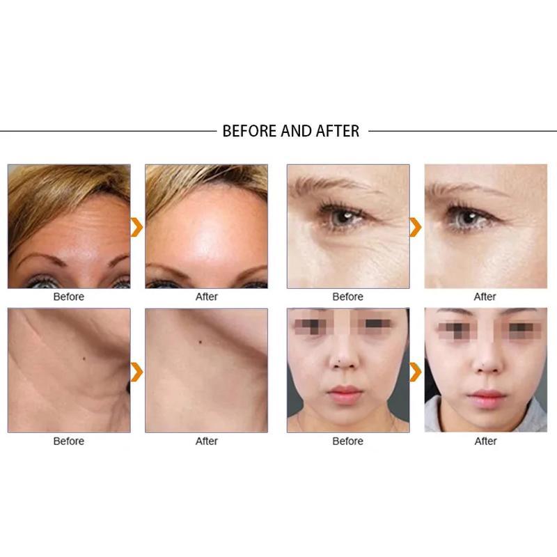 آلة شد الجلد عالية التردد لعام 2023 VDHF rf radio أفضل جهاز لإزالة التجاعيد ومعدات العناية بالوجه رفع ملامح الوجه