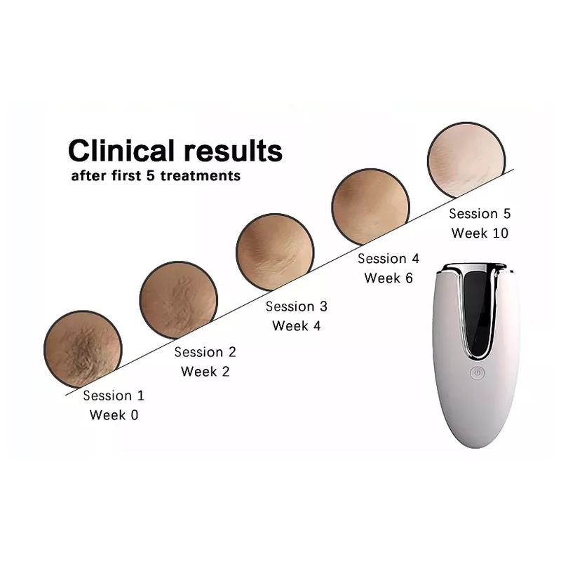 منتجات منزلية شائعة آلة إزالة الشعر بالليزر المحمولة باليد لإزالة الشعر بالليزر في المنزل