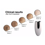 منتجات منزلية شائعة آلة إزالة الشعر بالليزر المحمولة باليد لإزالة الشعر بالليزر في المنزل