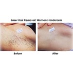 آلة إزالة الشعر بالضوء النبضي المكثف من نوع جديد