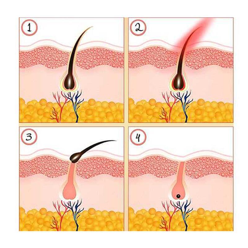 آلة إزالة الشعر بالضوء النبضي المكثف من نوع جديد