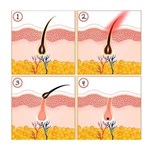 آلة إزالة الشعر بالضوء النبضي المكثف من نوع جديد