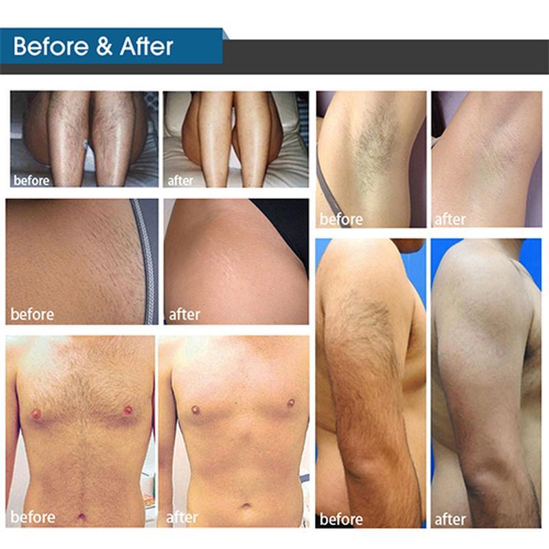 آلة إزالة الشعر بالضوء النبضي المكثف من نوع جديد