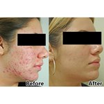 جهاز علاج الوجه بالضوء الأحمر لعلاج حب الشباب وتجديد شباب البشرة بعلاج الضوء الديناميكي الضوئي بقيادة CE المعتمدة