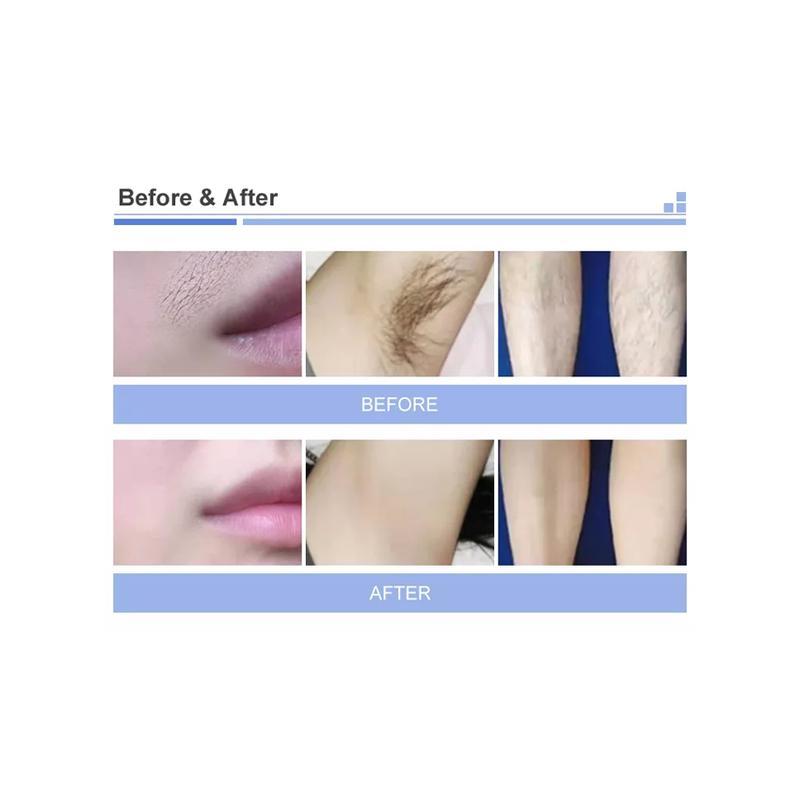 ثنائي المقابض 3 أطوال موجية ليزر ديود 808 نانومتر إزالة الشعر علاج جمال آلة