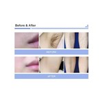 ثنائي المقابض 3 أطوال موجية ليزر ديود 808 نانومتر إزالة الشعر علاج جمال آلة