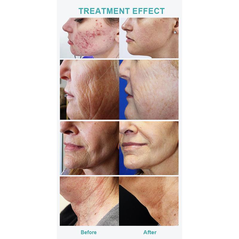 جهاز ميكرونيدلينج احترافي لإزالة الندبات وتشدّيد البشرة مع إبر دقيقة