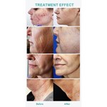 جهاز ميكرونيدلينج احترافي لإزالة الندبات وتشدّيد البشرة مع إبر دقيقة