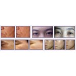 جهاز رفع البلازما جهاز تجميل البلازما المنزلي