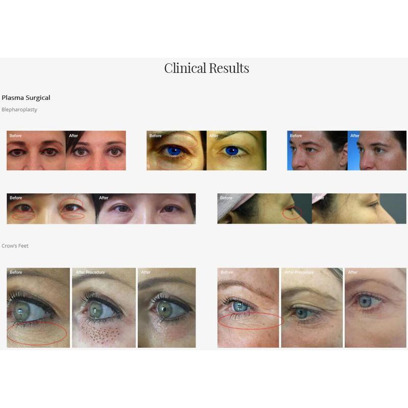 جهاز بلازما بين للعناية بالبشرة وعلاج حب الشباب