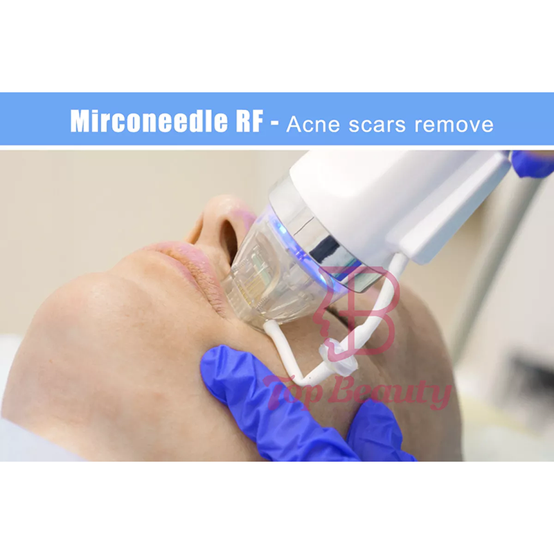 آلة الوخز الدقيقة الجزئية إبرة الراديو الترددي